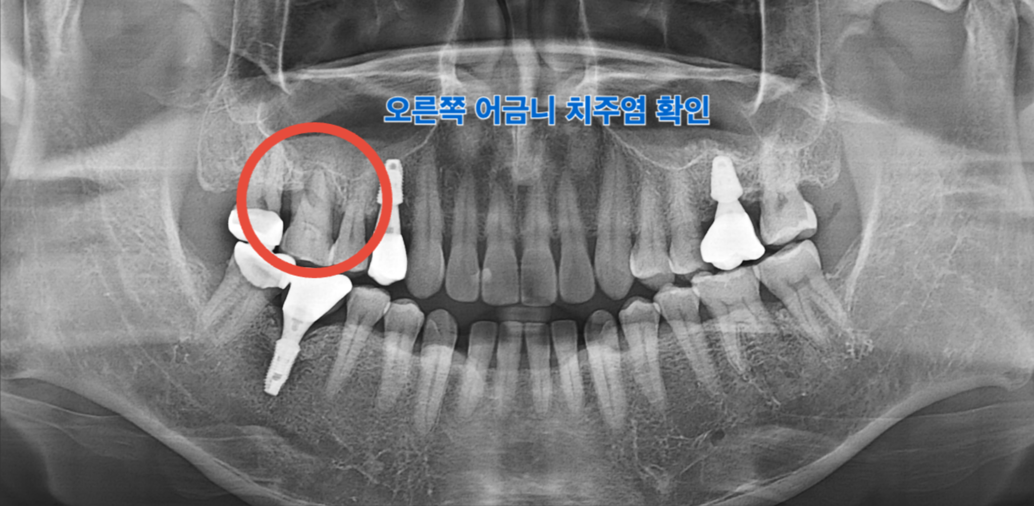 치료 전 16번 치아 상태