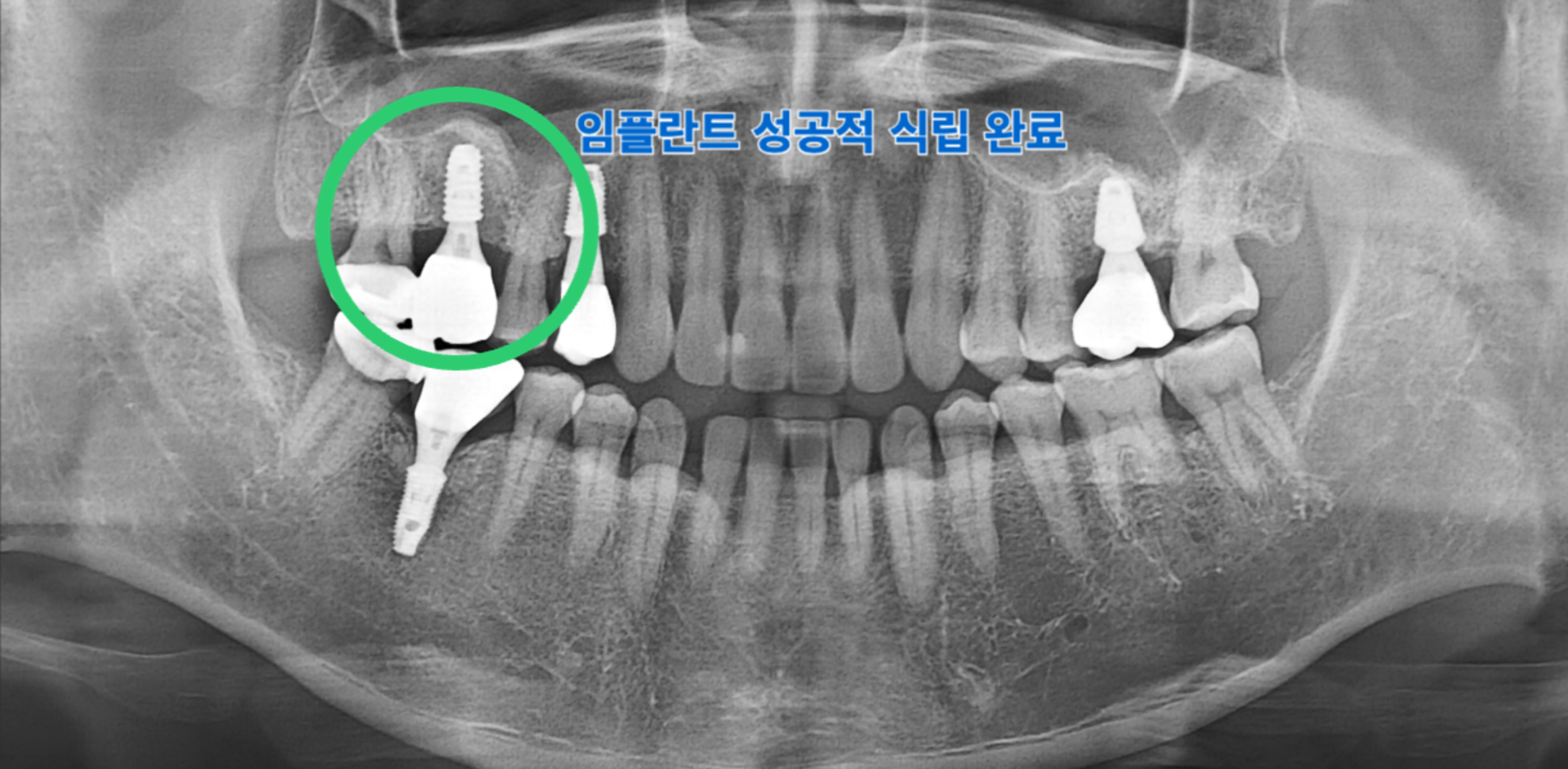 치료 후 16번 보철 완성