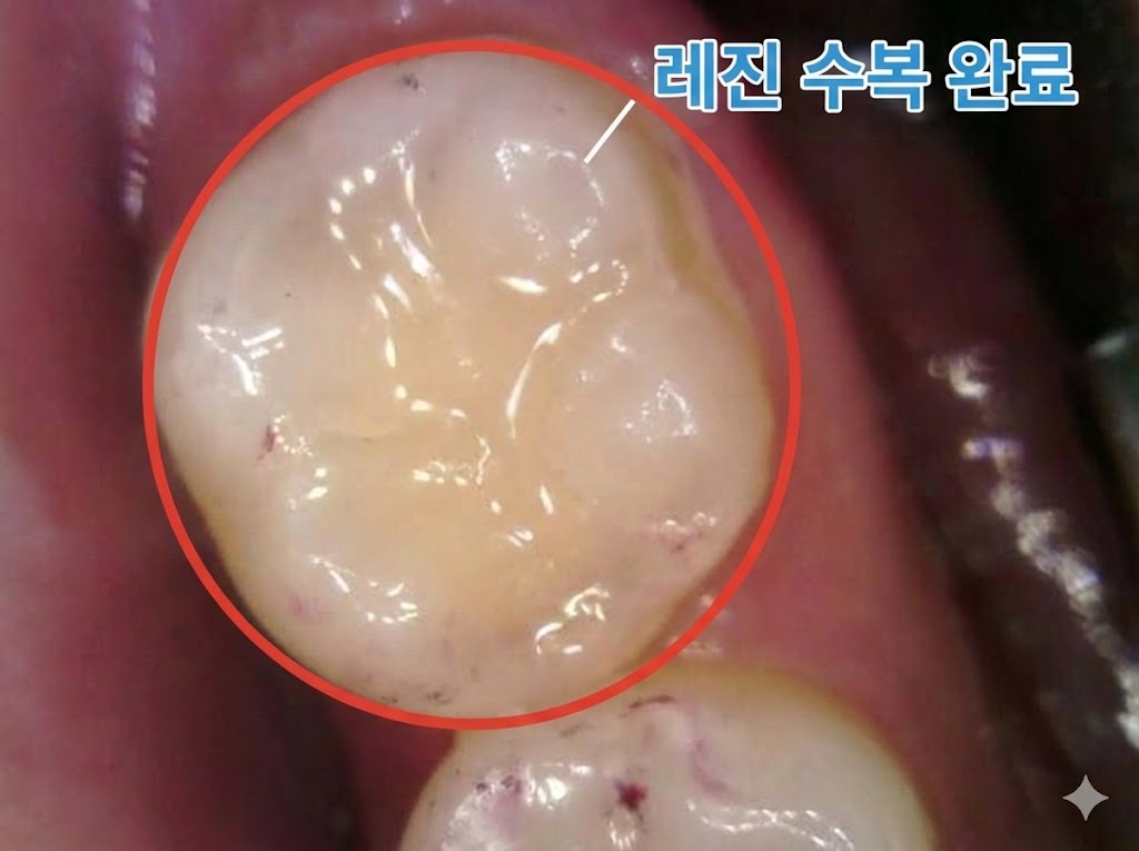 치료 후 레진/인레이 수복 완료
