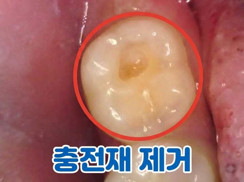 치료 전 어금니 충치 및 오래된 충전재 상태