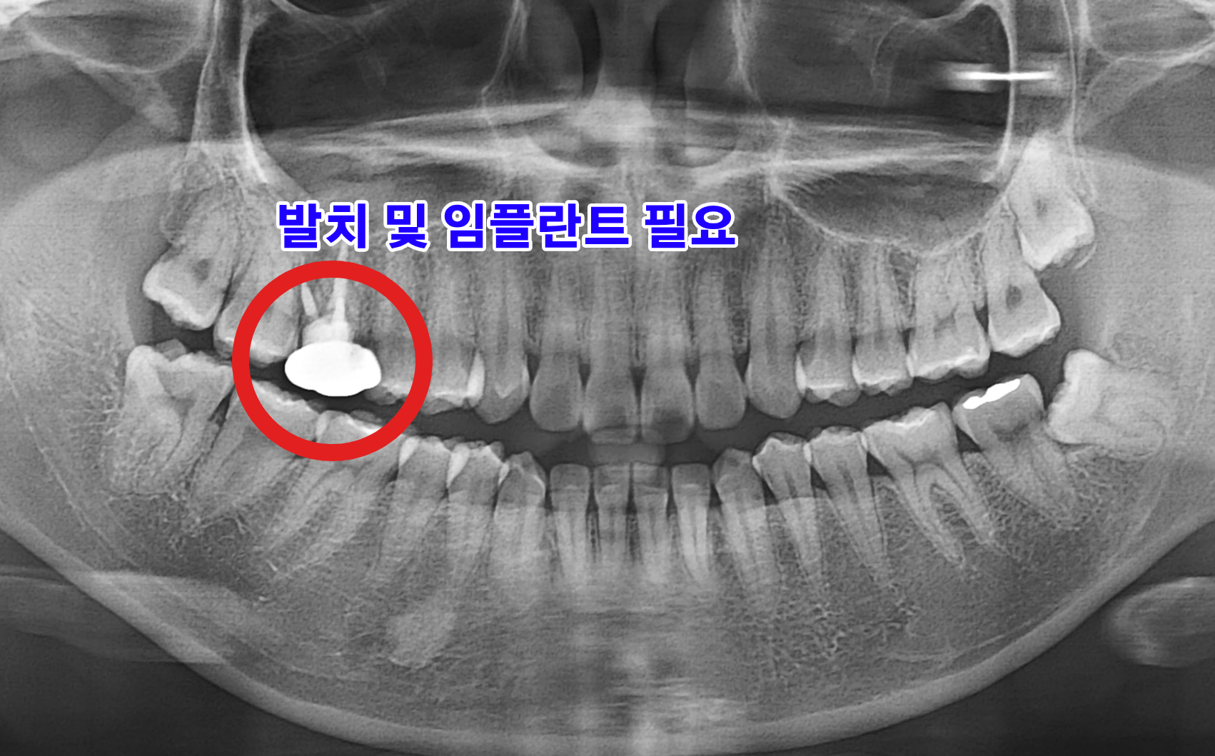 치료 전 파노라마 엑스레이