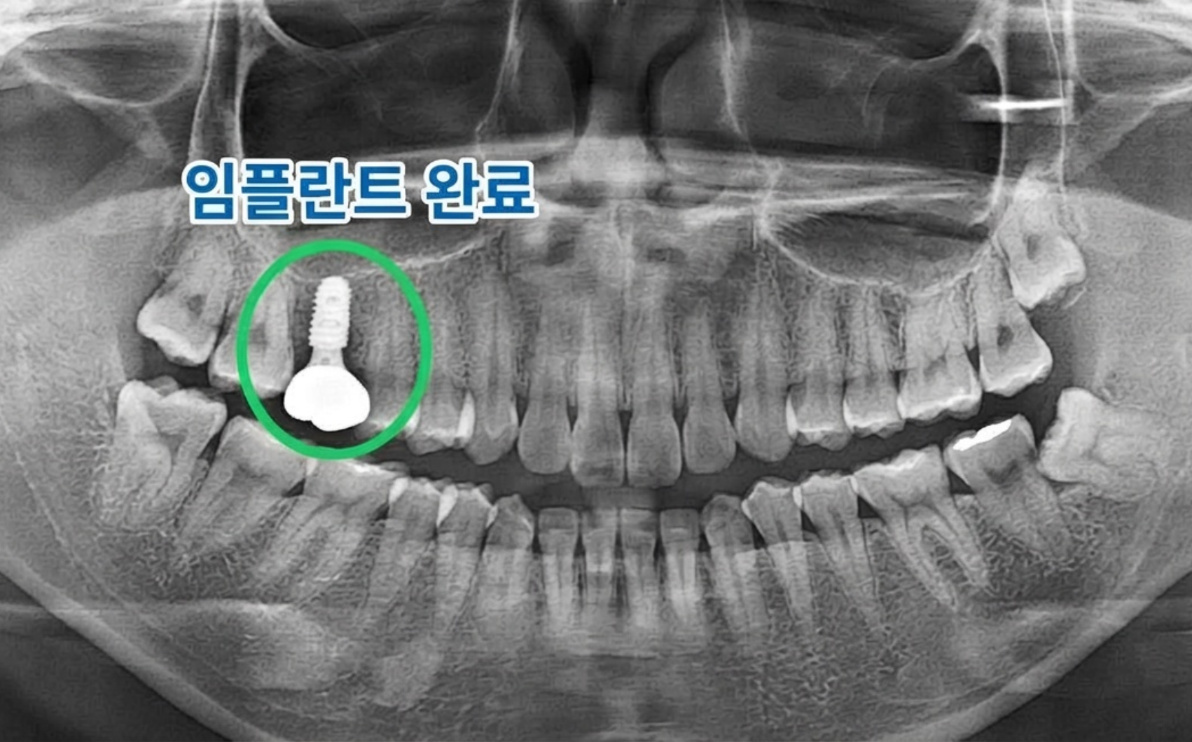치료 후 파노라마 엑스레이